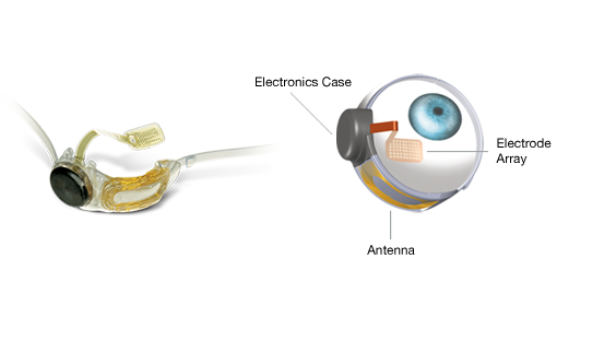 Argus II Implant. Bionic Eye