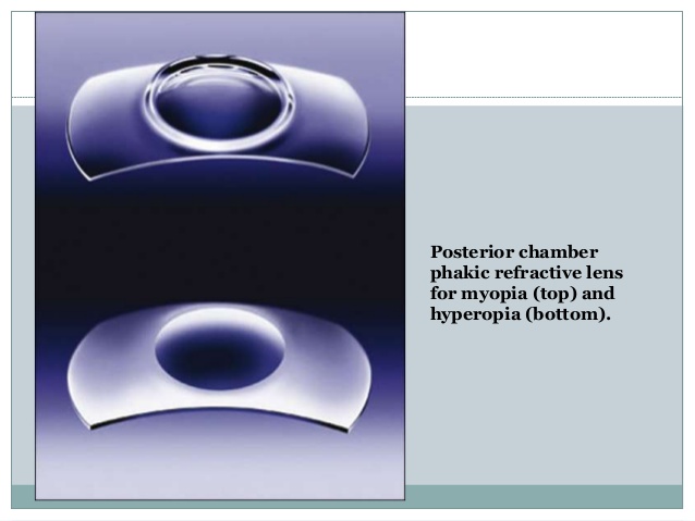 PRL. Phakic refractive lens