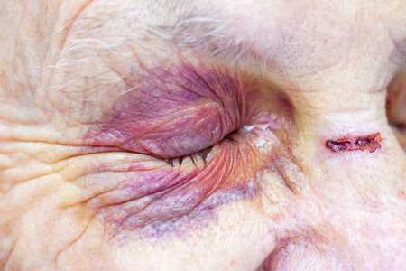 Pain in the eye after trauma