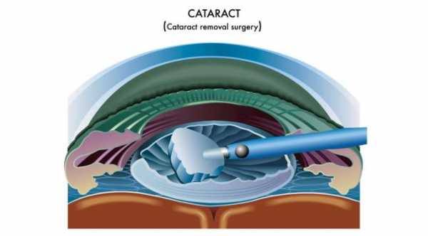 Common Symptoms After Cataract Surgery