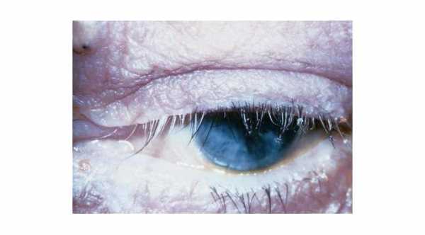 Complications of Blepharitis. Madarosis and Poliosis of the eyelashes due to chronic inflammation in blepharitis.© 2019 American Academy of Ophthalmology