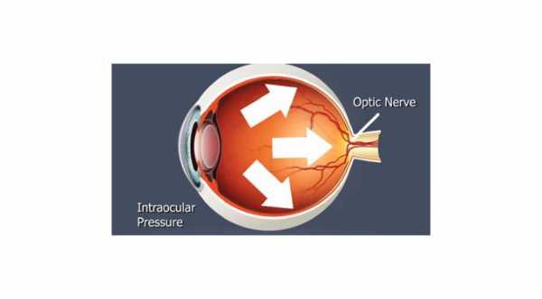 High Intraocular Pressure After Cataract Surgery
