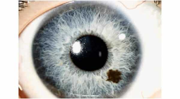 Iris Nevus is a benign brown pigmented area over the iris which can be either flat or slightly elevated area