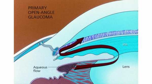 Primary Open Angle Glaucoma © 2019 American Academy of Ophthalmology
