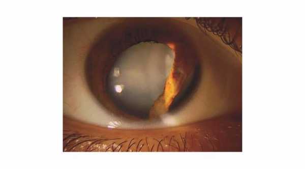 Traumatic Cataract with iridodialysis. © 2019 American Academy of Ophthalmology