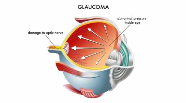 Treatments of Glaucoma
