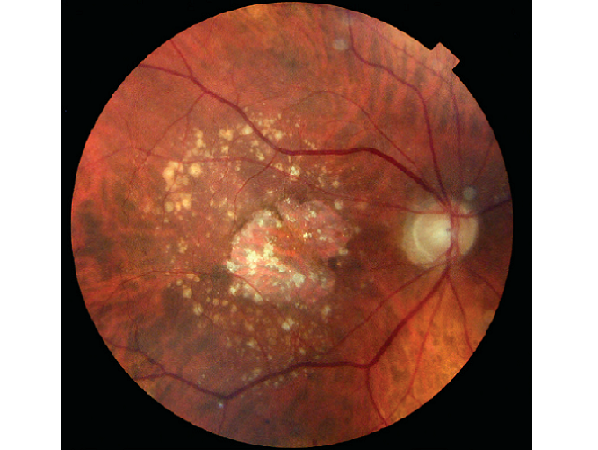 Dry Age Related Macular Degeneration. Severe dry macular degeneration with large geographic atrophy and multiple drusens