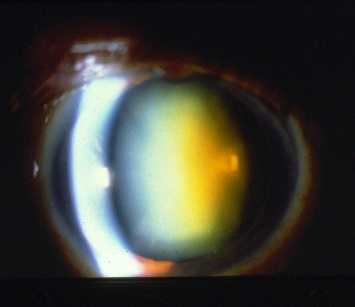 Nuclear Cataract Associated with Macular Hole Repair