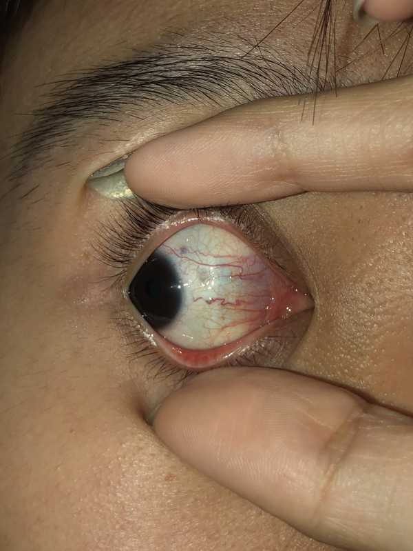 Yellowish stuff on the inner corner of my eye