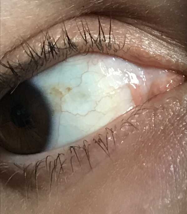 Brown spot in my eye-1