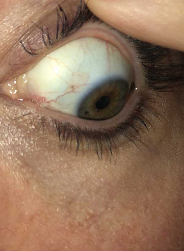 Eye allergies or normal?