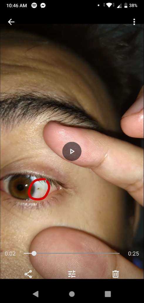Black dot on the white part of eye