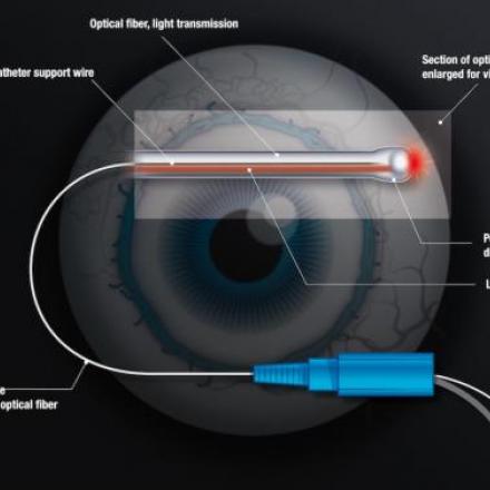 ABiC Glaucoma Procedure. itrack diaghram