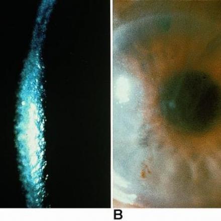 Fuchs Endothelial Dystrophy. Corneal edema in patients with Fuchs Endothelial Dystrophy © 2019 American Academy of Ophthalmology