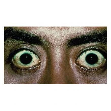 Thyroid eye disease with proptosis or exophthalmos. © 2019 American Academy of Ophthalmology
