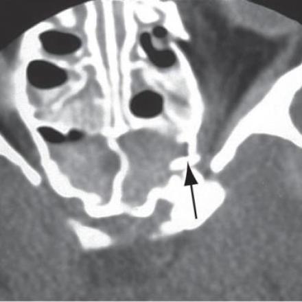 Traumatic Optic Neuropathy. CT scan of patient involved in a severe motor vehicle accident.There is fracture in the area of the left optic canal, with a bone fragment (arrow) impinging on the left optic nerve. © 2019 American Academy of Ophthalmology