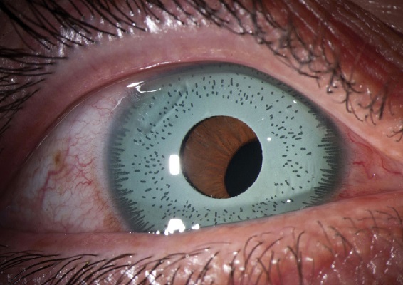 عملية تغيير لون العين جراحيا. زرع القزحية الاصطناعية داخل العين لتغيير لون العين. الثقب في القزحية الاصطناعية ليست على نفس مستوى بؤبؤ العين الطبيعي