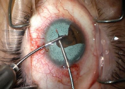 عملية تغيير لون العين جراحيا. عملية ازالة القزحية الاصطناعية من داخل العين 