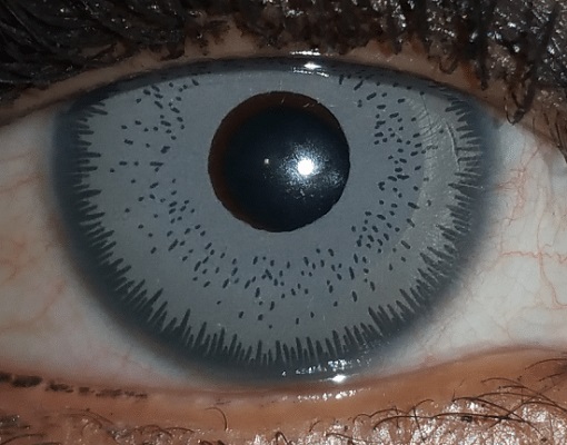عملية تغيير لون العين جراحيا. زرع القزحية الاصطناعية داخل العين لتغيير لون العين