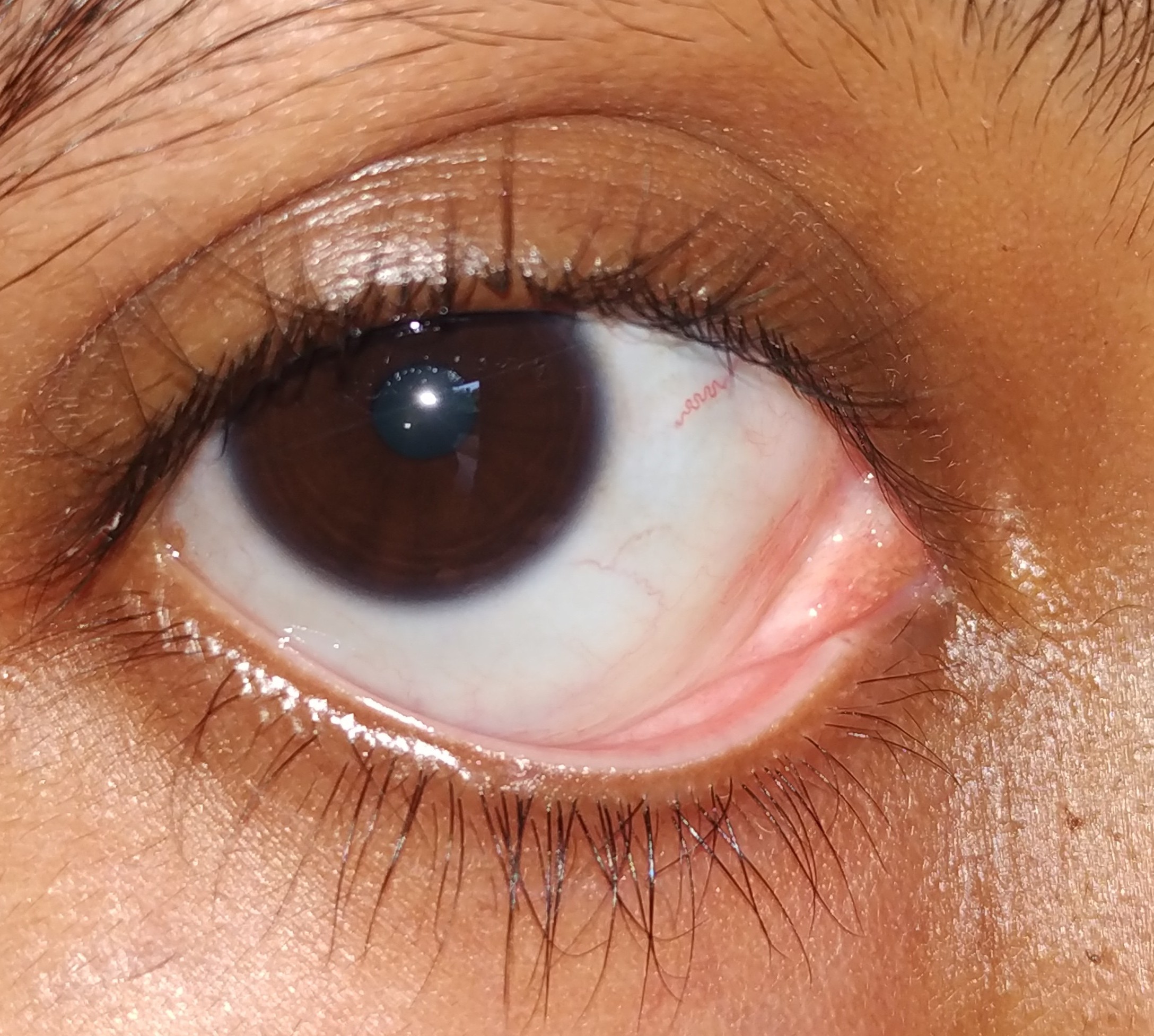 Lacrimal Caruncle with white dots