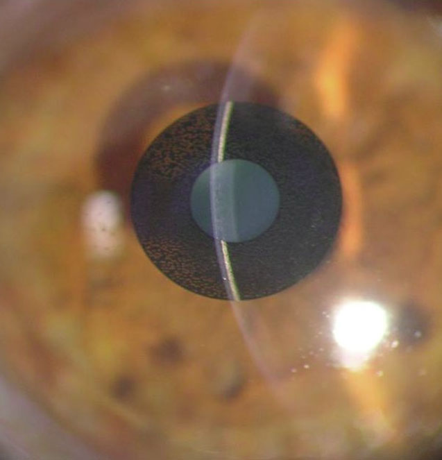 Kamra inlay for presbyopia treatment