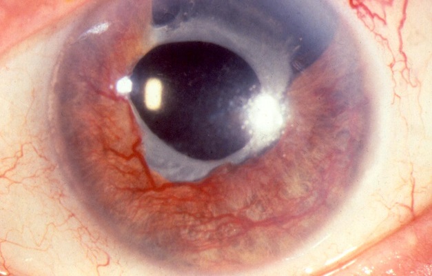 Neovascular Glaucoma with new blood vessels appear on the iris