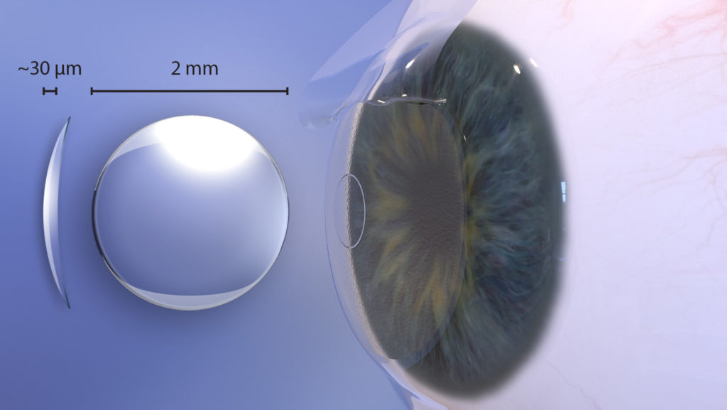 Raindrop Corneal inlays for presbyopia