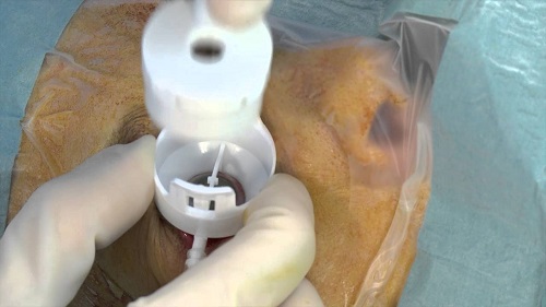 Ultrasound ciliary plasty Procedure with EyeOP1 device