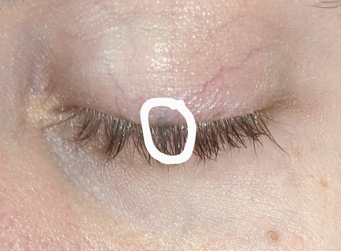 Brown discoloration in the upper eyelid