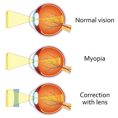 Myopia Correction