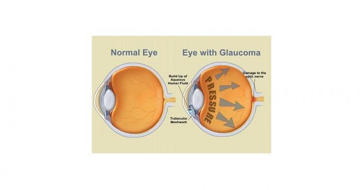 Глаукома латынь. Глаукома и катаракта отличия. Шкала DDLS глаукома.