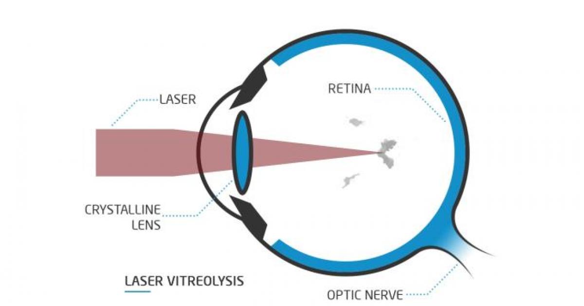 Vitreolysis For Eye Floaters | eye treatment | Webeyeclinic