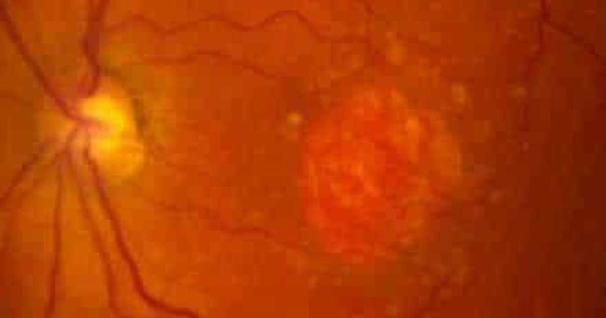 Тест сетчатки глаза. Ангиосклероз сетчатки глаза что это такое. Тест на патологии сетчатки. Гипертонический ангиосклероз сетчатки. Заболевания сетчатки рисунок.