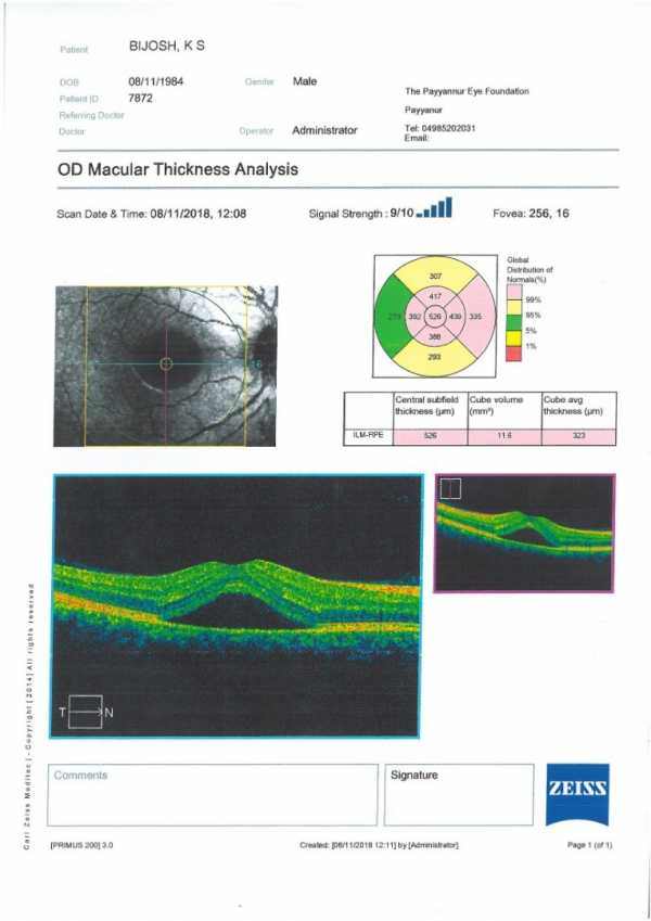 High Macular thickness