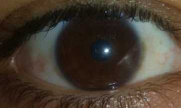 Yellow bump in my eye