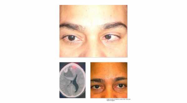 Abducens Nerve Palsy. Large tumor in the left hemisphere cause left sixth nerve palsy © 2019 American Academy of Ophthalmology