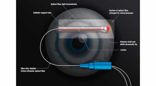 ABiC Glaucoma Procedure. itrack diaghram