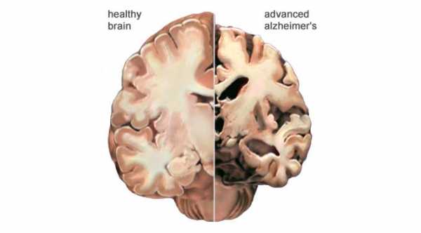 Alzheimer Dementia. Correlation between alzheimer dementia and peripheral retinal examination