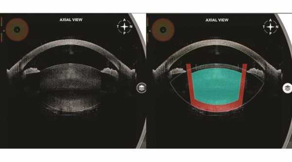 Anterior Capsule Tear in Femtosecond Cataract Surgery © 2019 American Academy of Ophthalmology