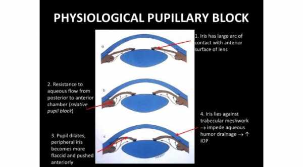 Causes of Pupillary Block