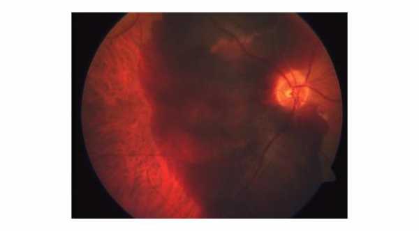 Choroidal hemorrhage. Subretinal collection of blood in patient with wet macular degeneration.© 2019 American Academy of Ophthalmology
