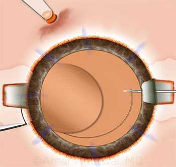 Complications of Glued Intraocular lens @ 2019 American academy of Ophthalmology