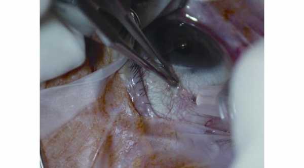 Complications of Intravitreal Injection © 2019 American Academy of Ophthalmology 