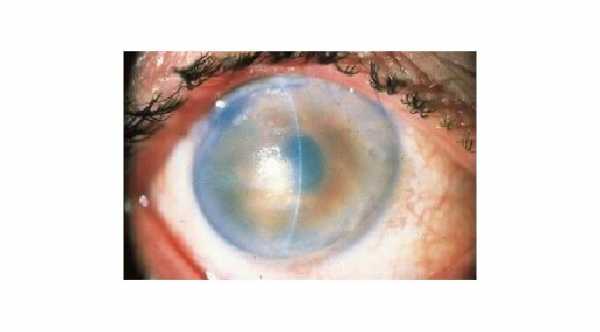 Corneal Edema After Cataract Surgery. Pseudophakic Bullous Keratopathy. It is corneal edema that occurred as a complication of cataract surgery.© 2019 American Academy of ophthalmology