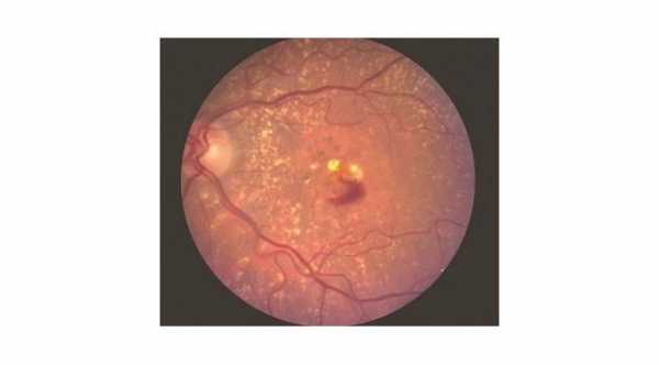 Definition of Age Related Macular Degeneration. Wet Age Related Macular Degeneration with Choroidal Neovascularization, blood and exudates at the macula © 2019 American Academy of ophthalmology