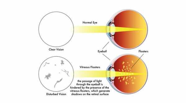 Definition Of Eye Floaters