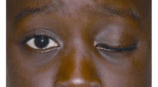Definition of Ptosis. This patient with left eye ptosis © 2019 American Academy of Ophthalmology