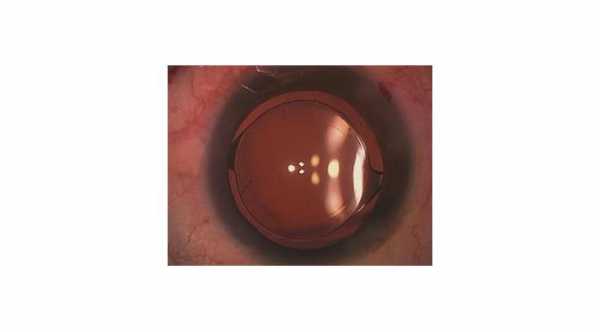 Eye Care After Cataract Surgery © 2019 American Academy of Ophthalmology