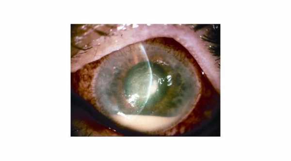 Eye Infection from Contact Lens . Whitish intraocular debris which is called hypopyon with corneal edema © 2019 American Academy of Ophthalmology