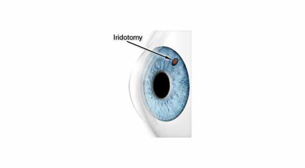 Eye Surgery For Glaucoma. Peripheral Laser Iridotomy